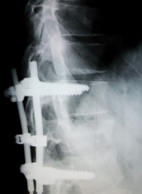Work Related Spinal Injury