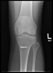 knee injury on the job at work