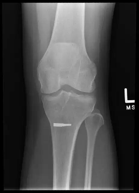 knee injury on the job at work