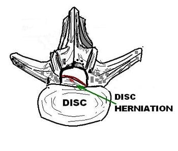 Herniated Disc