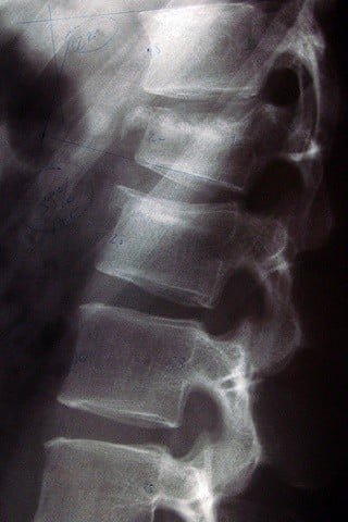 Work-related spine injuries can be painful and debilitating.