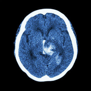 Intracerebral Hemorrhage Lawyer