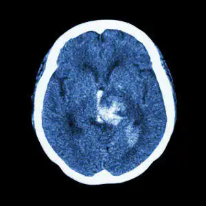 Intracerebral Hemorrhage Lawyer