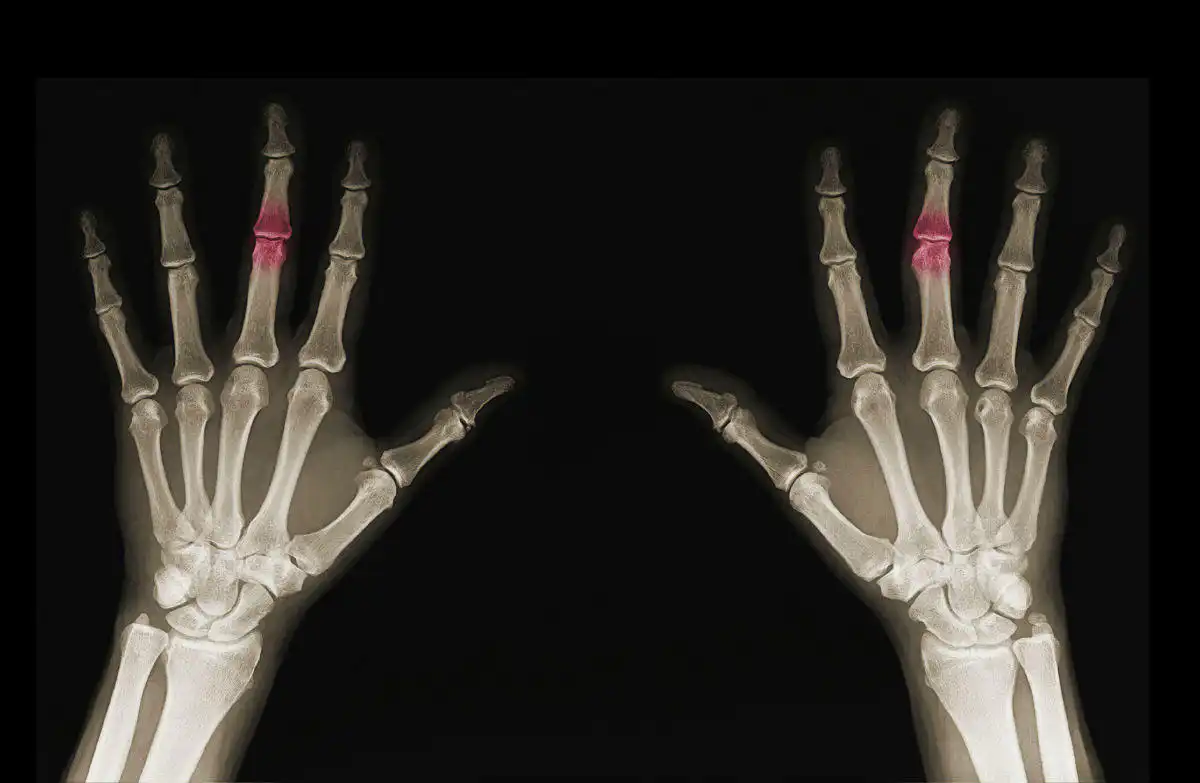 Degenerative Bone Disease
