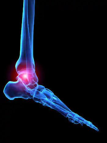 plantar fascitis