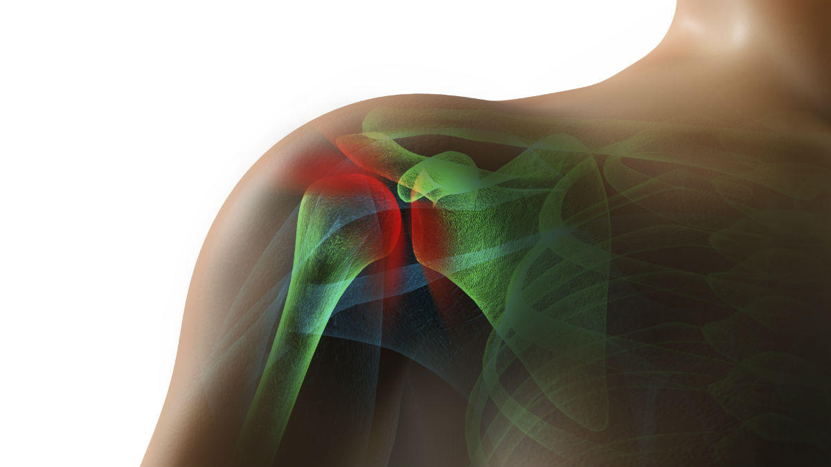 rotator cuff tear