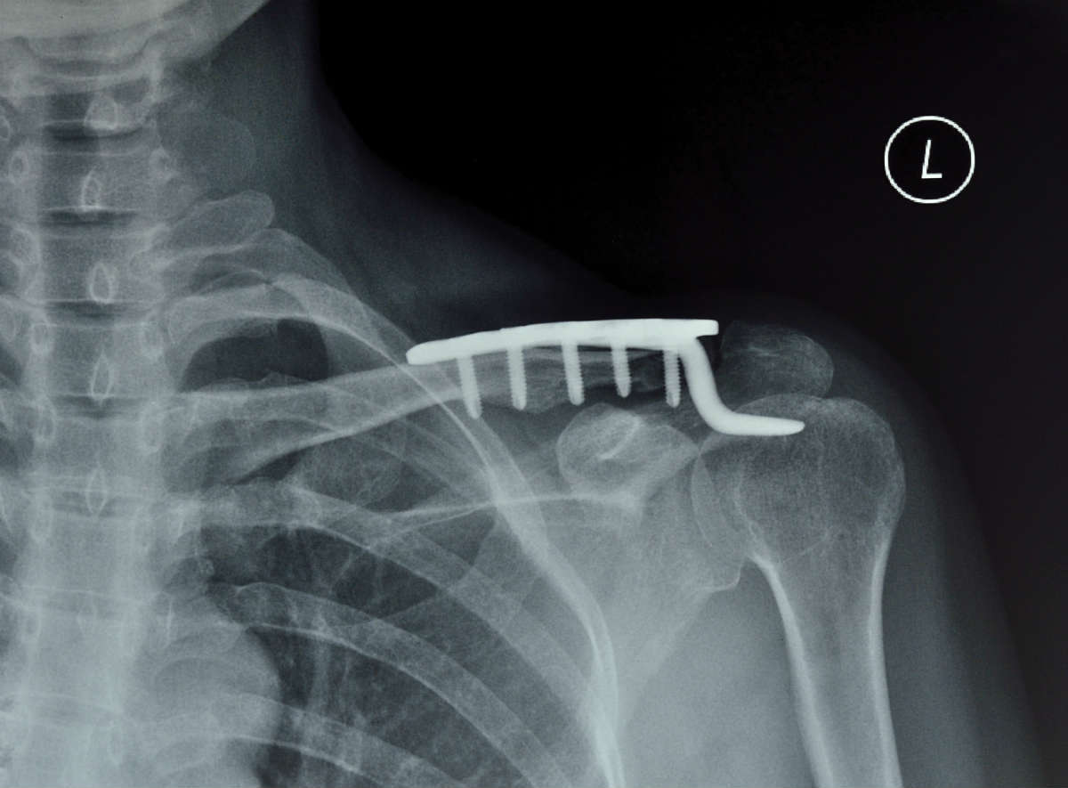 Shoulder Fusion Lawyer Missouri Workers Compensation Benefits