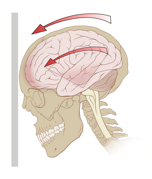 concussion-workers-compensation-Missouri