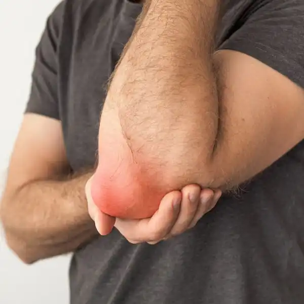 Missouri Workers Compensation Claims for-Bursitis Injuries
