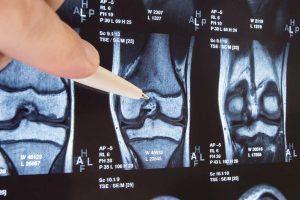 What Is Occupational Osteoarthritis?